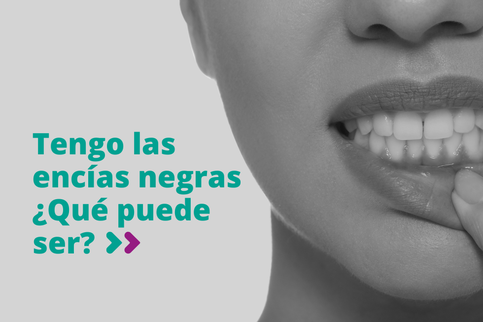 Tengo las encías negras ¿qué puede ser?