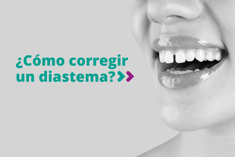 Cómo corregir diastema en Pedrera