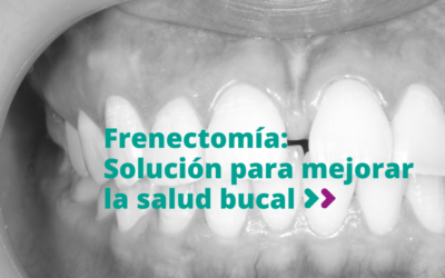 Frenectomía: Solución para mejorar la salud bucal