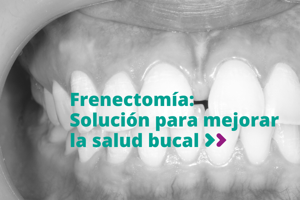 Frenectomía: Solución para mejorar la salud bucal