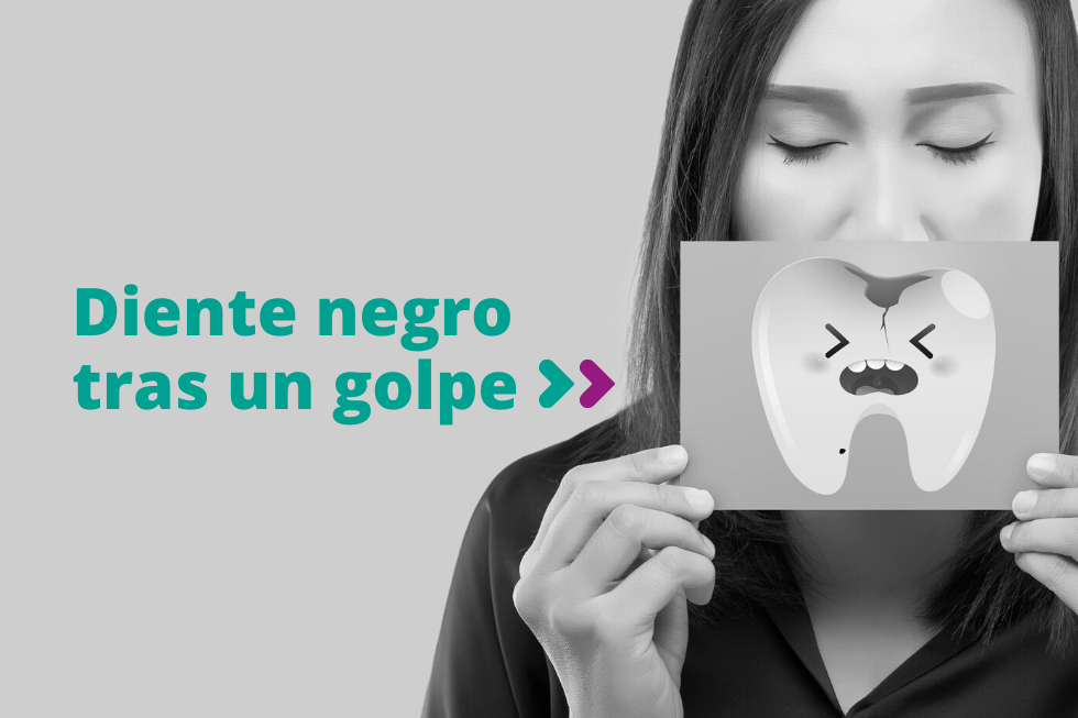 Diente negro tras un golpe, ¿qué puedes hacer?