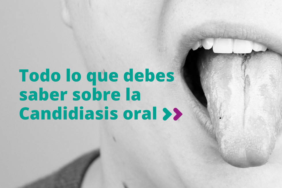 Todo lo que debes saber sobre la Candidiasis oral