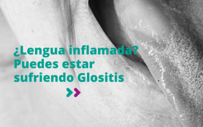 Si tienes la lengua inflamada puedes estar sufriendo Glositis