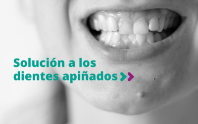 Solución a los dientes apiñados