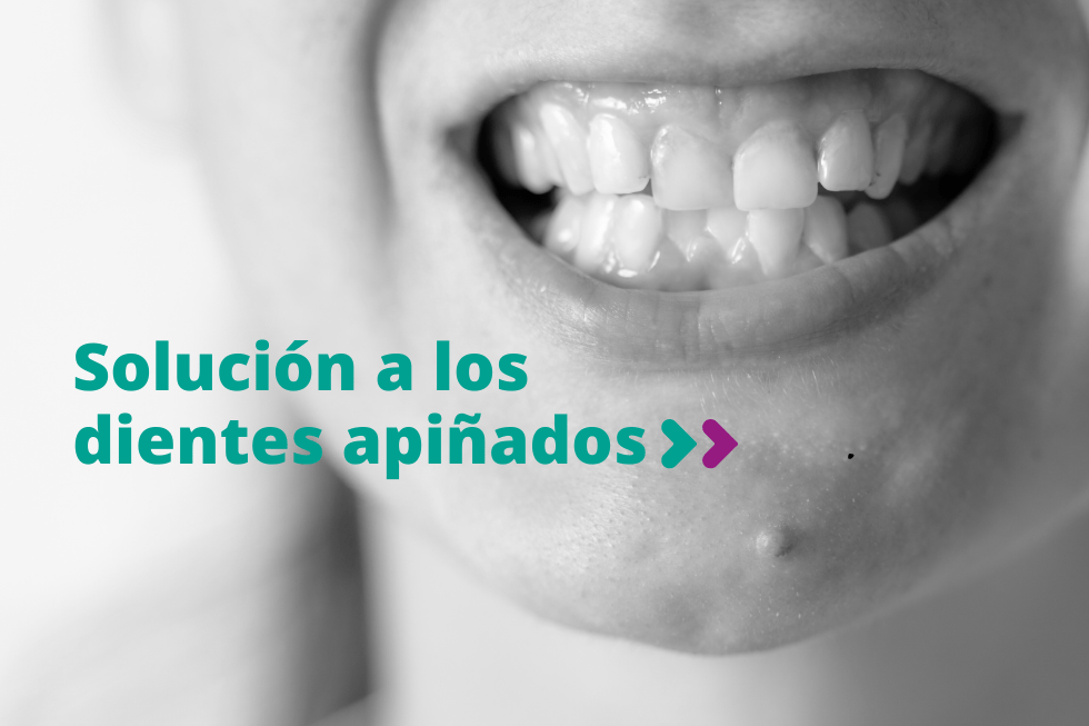 Solución a los dientes apiñados