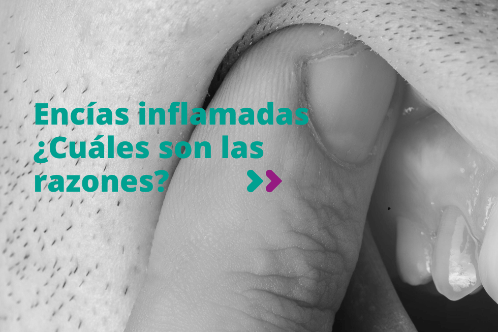 Encías inflamadas. Cuáles son las razones