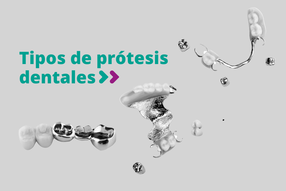 Tipos de prótesis dentales