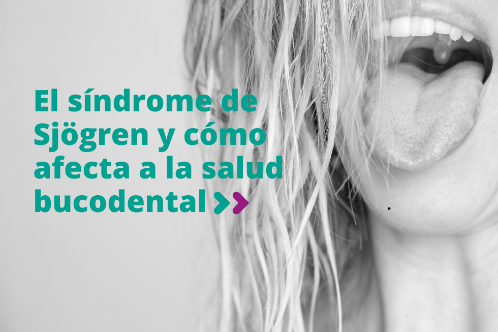 El síndrome de Sjögren y cómo afecta a la salud bucodental