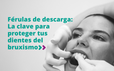 Férulas de descarga: La clave para proteger tus dientes del bruxismo