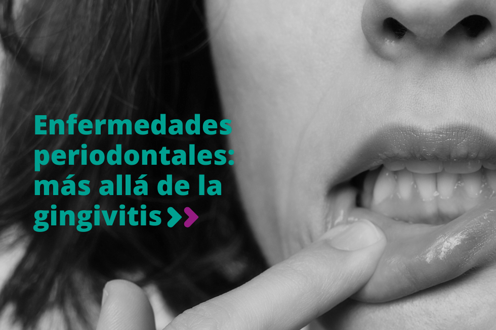 Enfermedades periodontales: más allá de la gingivitis