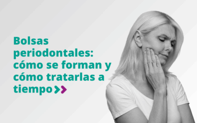 Bolsas periodontales: cómo se forman y cómo tratarlas a tiempo