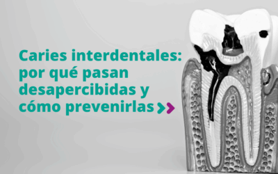 Caries interdentales: por qué pasan desapercibidas y cómo prevenirlas
