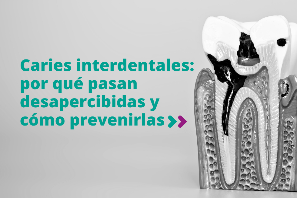 Caries interdentales: por qué pasan desapercibidas y cómo prevenirlas