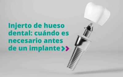 Injerto de hueso dental: cuándo es necesario antes de un implante
