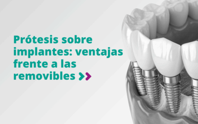 Prótesis sobre implantes: ventajas frente a las removibles
