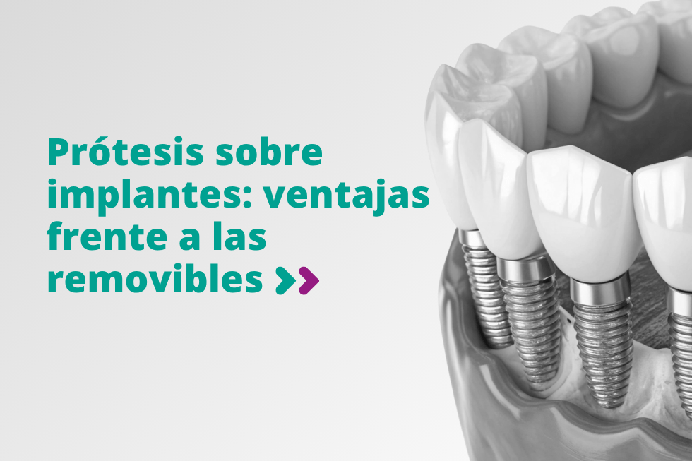 prótesis sobre implantes: ventajas frente a las removibles