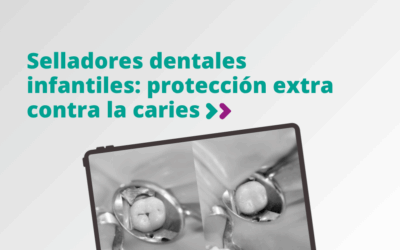 Selladores dentales infantiles: protección extra contra la caries