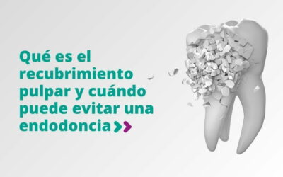 Qué es el recubrimiento pulpar y cuándo puede evitar una endodoncia