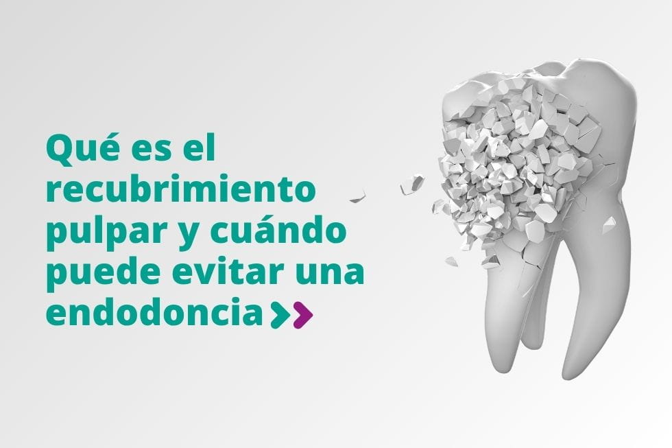 Qué es el recubrimiento pulpar y cuándo puede evitar una endodoncia