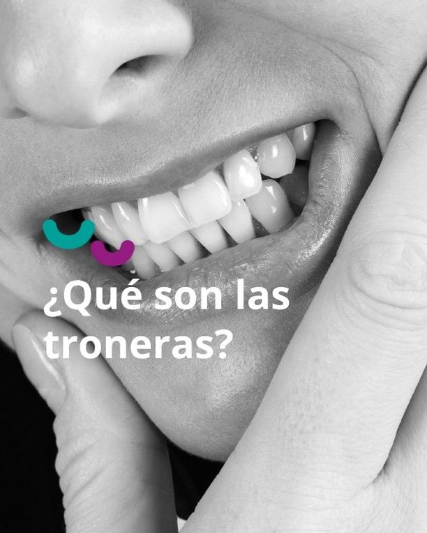 Las troneras dentales son una de las secuelas de la periodontitis.

¿Por qué? Porque se retrae la encía y se produce una pérdida del hueso del soporte. A medida que la raíz va quedano más expuesta, también son más evidentes estas troneras gingivales. 

Aunque pueden aparecer por el paso del tiempo o la propia morfología del diente, es importante que si se experimenta una alta sensibilidad o se producen desplazamientos en los dientes, se acuda inmediatamente al dentista.  Si necesitas más información, puedes entrar en nuestro blog, donde te informamos sobre cómo combatir la aparición de estos huecos negros entre los dientes. 

En Isdent podemos ayudarte a combatir las troneras dentales aportando diferentes soluciones. Ven a la consulta y analizaremos tu caso de manera personalizada. 

📍C. Nardo, 15. Pedrera, Sevilla
📞 660 834 040

#pedrera #pedrerasevilla #sevilla #gilena #martindelajara #estepa #osuna #larodadeandalucia #gingivitis #periodontitis #piorrea #enfermedadperiodontal #periodoncia #encias #saluddental #dientessanos